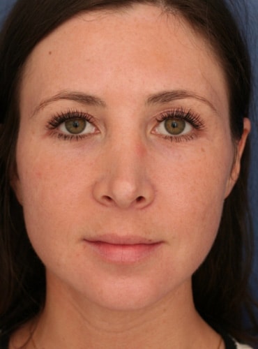 After Image: Rhinoplasty - front