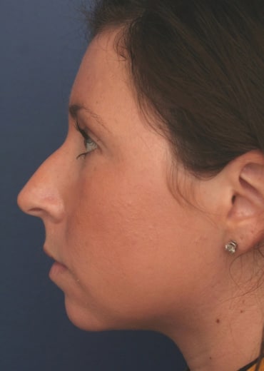 Before Image: Rhinoplasty - left-side