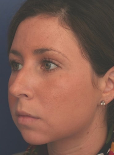 Before Image: Rhinoplasty - left-front-oblique