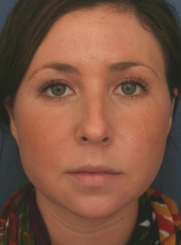 Before Image: Chin Surgery - front
