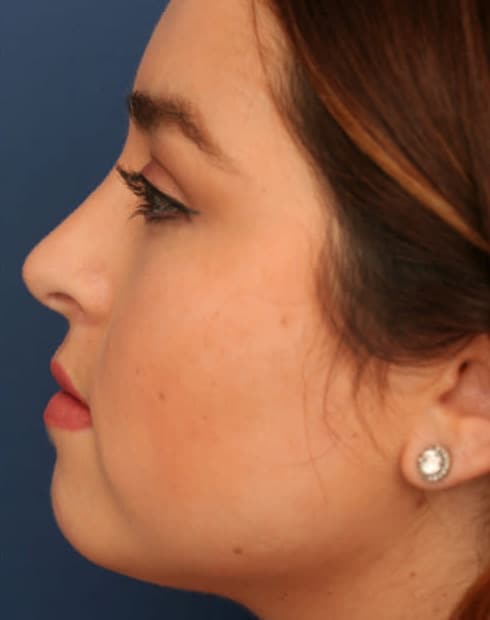 After Image: Ethnic Rhinoplasty - left-side