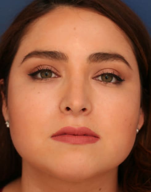 After Image: Ethnic Rhinoplasty - front
