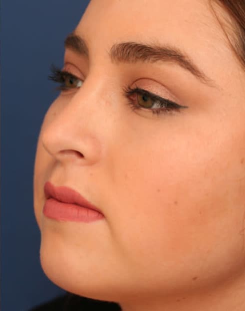 After Image: Ethnic Rhinoplasty - left-front-oblique