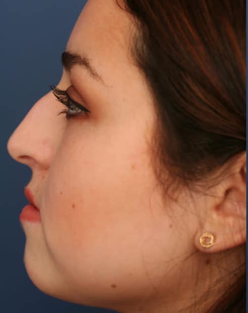 Before Image: Ethnic Rhinoplasty - left-side