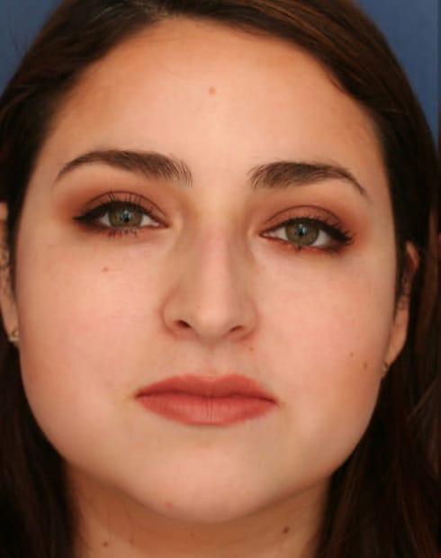 Before Image: Ethnic Rhinoplasty - front