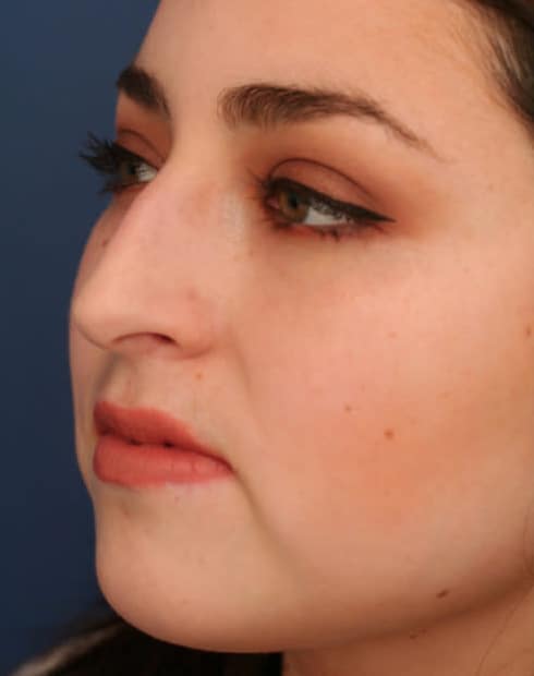 Before Image: Ethnic Rhinoplasty - left-front-oblique