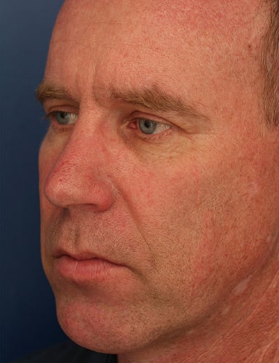 After Image: Rhinoplasty - left-front-oblique