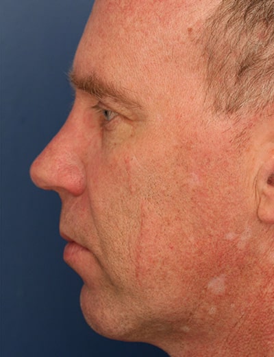 After Image: Rhinoplasty - left-side