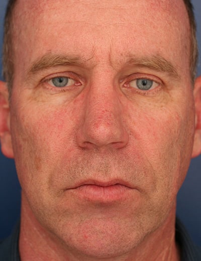 After Image: Rhinoplasty - front