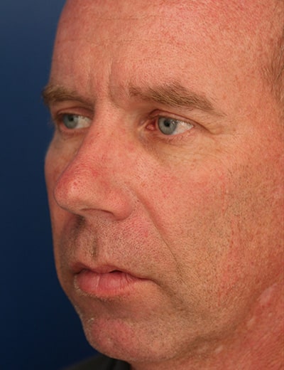 Before Image: Rhinoplasty - left-front-oblique
