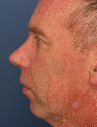 Before Image: Rhinoplasty - left-side