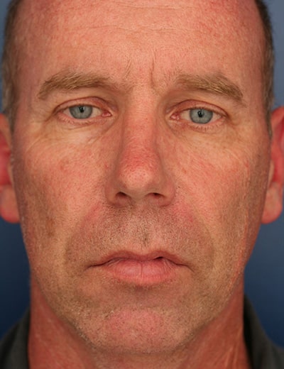 Before Image: Rhinoplasty - front