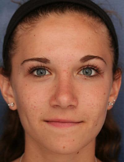 After Image: Rhinoplasty - front