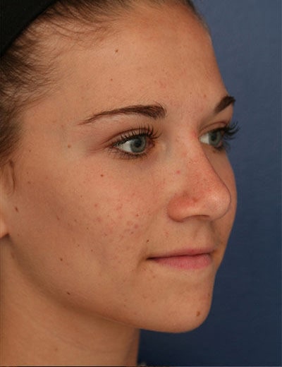 After Image: Rhinoplasty - right-front-oblique