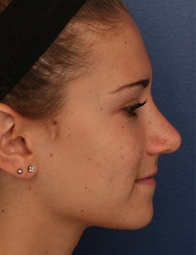 After Image: Rhinoplasty - right-side
