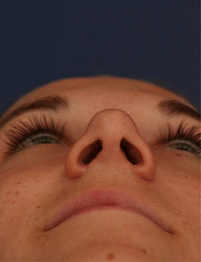 After Image: Rhinoplasty - front