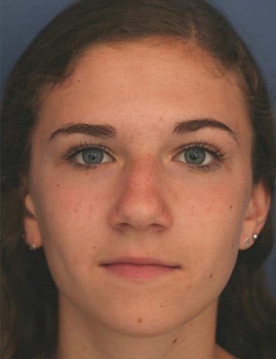 Before Image: Rhinoplasty - front