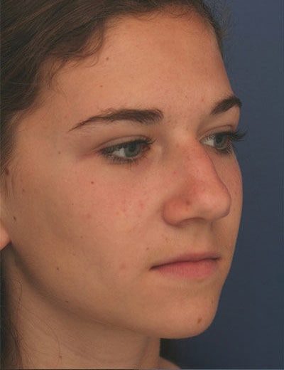Before Image: Rhinoplasty - right-front-oblique