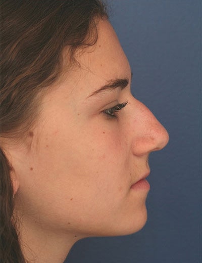Before Image: Rhinoplasty - right-side