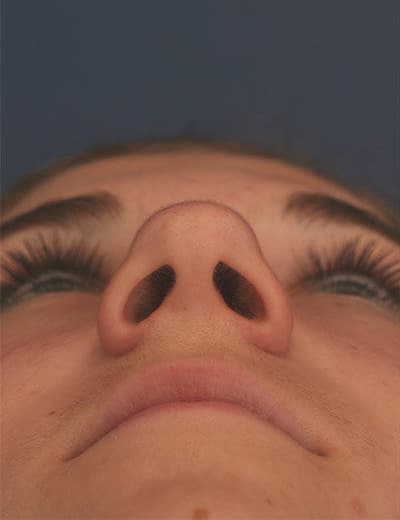 Before Image: Rhinoplasty - front