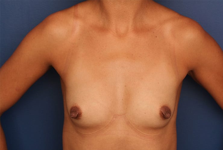 Before Image: Breast Augmentation - front