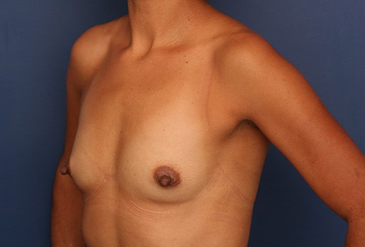 Before Image: Breast Augmentation - left-front-oblique
