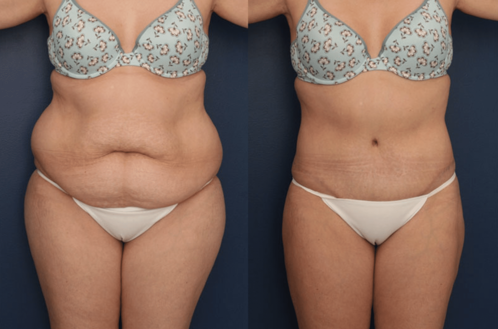 tummy tuck b a