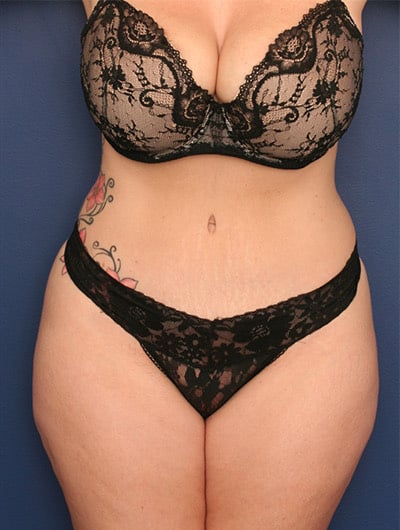 After Image: Tummy Tuck - front