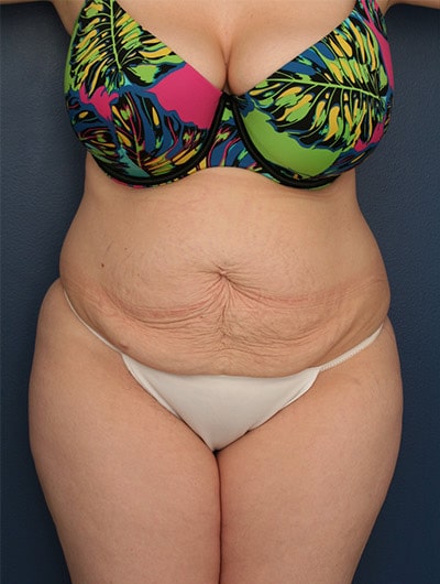 Before Image: Tummy Tuck - front