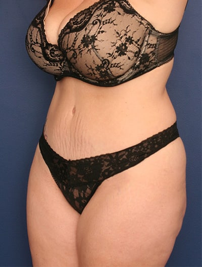 After Image: Tummy Tuck - left-front-oblique