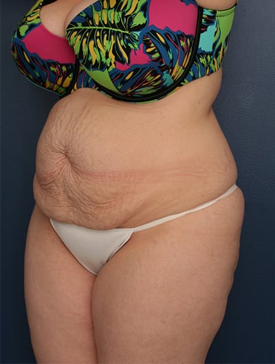 Before Image: Tummy Tuck - left-front-oblique