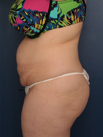 Before Image: Tummy Tuck - left-side