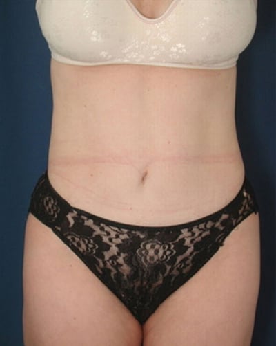 After Image: Tummy Tuck - front