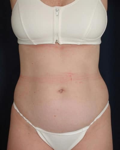 Before Image: Tummy Tuck - front