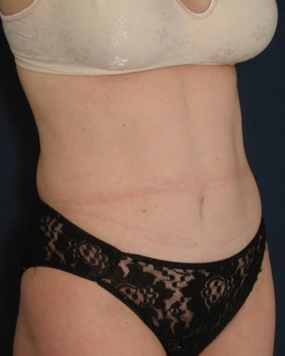 After Image: Tummy Tuck - right-front-oblique