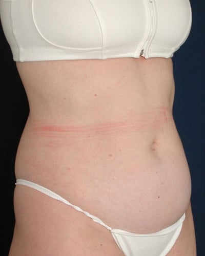 Before Image: Tummy Tuck - right-front-oblique
