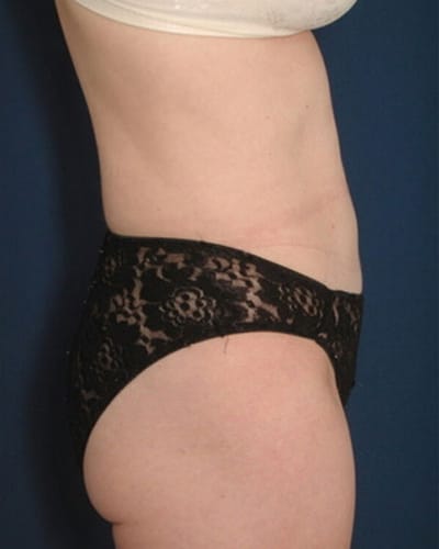After Image: Tummy Tuck - right-side
