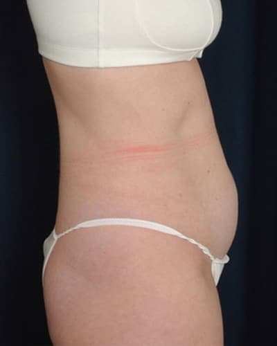 Before Image: Tummy Tuck - right-side