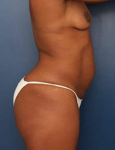 Before Image: Tummy Tuck - right-side