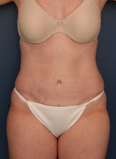 After Image: Tummy Tuck - front