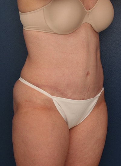 After Image: Tummy Tuck - right-front-oblique