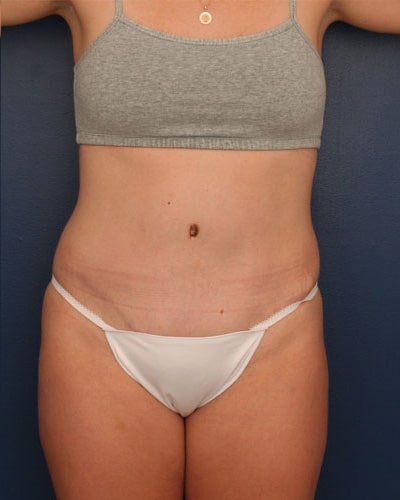 After Image: Tummy Tuck - front