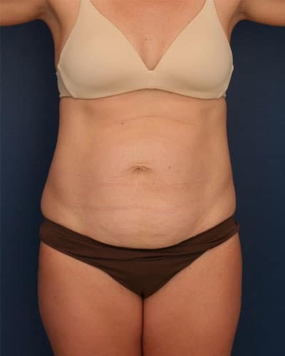 Before Image: Tummy Tuck - front