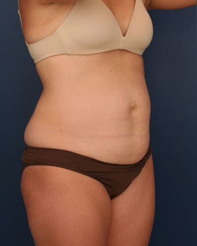 Before Image: Tummy Tuck - right-front-oblique