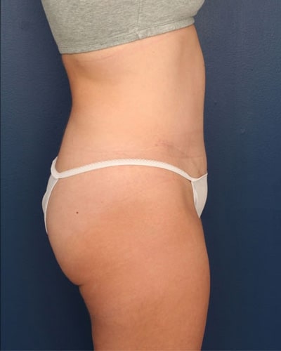 After Image: Tummy Tuck - right-side