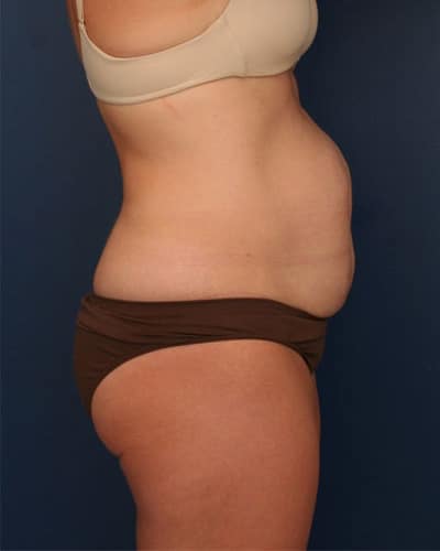 Before Image: Tummy Tuck - right-side