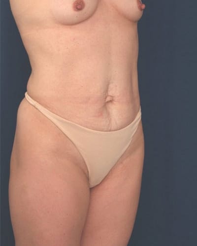 Before Image: Tummy Tuck - right-front-oblique