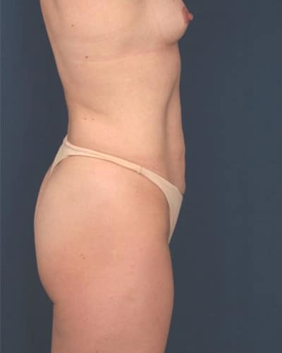 Before Image: Tummy Tuck - right-side