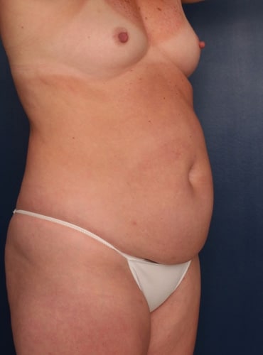 Before Image: Tummy Tuck - right-front-oblique