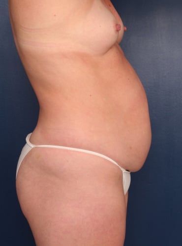 Before Image: Tummy Tuck - right-side